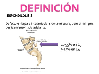 • ESPONDILÓLISIS
Defecto en la pars interarticularis de la vértebra, pero sin ningún
deslizamiento hacia adelante.
71-95% en L5
5-15% en L4
 
