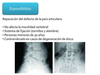Espondilólisis
Reparación del defecto de la pars articularis
• No afecta la movilidad vertebral
• Sistema de fijación (tornillos y alambre)
• Personas menores de 30 años
• Contraindicado en casos de degeneración de disco
 