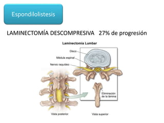 Espondilolistesis
LAMINECTOMÍA DESCOMPRESIVA 27% de progresión
 