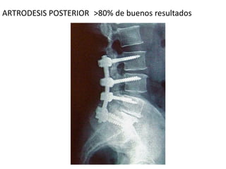 ARTRODESIS POSTERIOR >80% de buenos resultados
 