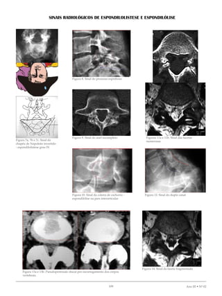 09 Ano III • Nº 02
SINAIS RADIOLÓGICOS DE ESPONDILOLISTESE E ESPONDILÓLISE
Figura 7a, 7b e 7c. Sinal do
chapéu de Napoleão invertido
- espondilolistese grau IV.
Figura 8. Sinal do processo espinhoso
Figura 9. Sinal do anel incompleto
Figura 10. Sinal da coleira de cachorro -
espondilólise na pars interarticular
Figuras 11a e 11b. Sinal das facetas
numerosas
Figura 12. Sinal do duplo canal
Figura 13a e 13b. Pseudoprotrusão discal por escorregamento dos corpos
vertebrais.
Figura 14. Sinal da faceta fragmentada
 