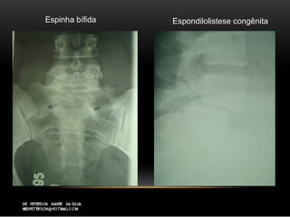 Espinha bífida Espondilolistese congênita
 