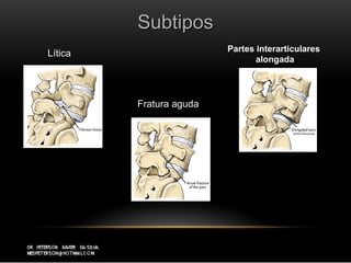 SubtiposSubtipos
Lítica
Fratura aguda
Partes interarticulares
alongada
 