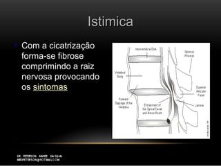IstimicaIstimica
 Com a cicatrizaçãoCom a cicatrização
forma-se fibroseforma-se fibrose
comprimindo a raizcomprimindo a raiz
nervosa provocandonervosa provocando
osos sintomassintomas
 