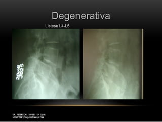 DegenerativaDegenerativa
Listese L4-L5
 