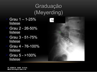 GraduaçãoGraduação
(Meyerding)(Meyerding)
 Grau 1 – 1-25%Grau 1 – 1-25%
listeselistese
 Grau 2 - 26-50%Grau 2 - 26-50%
listeselistese
 Grau 3 - 51-75%Grau 3 - 51-75%
listeselistese
 Grau 4 - 76-100%Grau 4 - 76-100%
listeselistese
 Grau 5 - >100%Grau 5 - >100%
listeselistese
 
