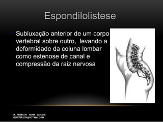 EspondilolisteseEspondilolistese
 Subluxação anterior de um corpoSubluxação anterior de um corpo
vertebral sobre outro, levando avertebral sobre outro, levando a
deformidade da coluna lombardeformidade da coluna lombar
como estenose de canal ecomo estenose de canal e
compressão da raiz nervosacompressão da raiz nervosa
 