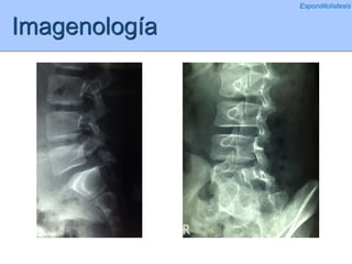 Imagenología
Espondilolistesis
 