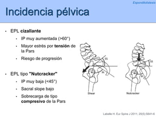 Incidencia pélvica
• EPL cizallante
• IP muy aumentada (>60°)
• Mayor estrés por tensión de
la Pars
• Riesgo de progresión
• EPL tipo "Nutcracker"
• IP muy baja (<45°)
• Sacral slope bajo
• Sobrecarga de tipo
compresivo de la Pars
Espondilolistesis
Labelle H. Eur Spine J 2011; 20(5):S641-6
 
