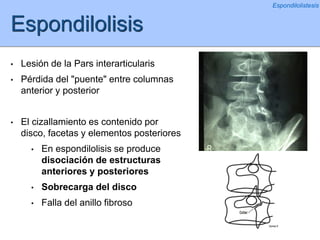 Espondilolisis
• Lesión de la Pars interarticularis
• Pérdida del "puente" entre columnas
anterior y posterior
• El cizallamiento es contenido por
disco, facetas y elementos posteriores
• En espondilolisis se produce
disociación de estructuras
anteriores y posteriores
• Sobrecarga del disco
• Falla del anillo fibroso
Espondilolistesis
 