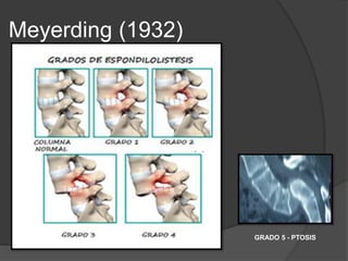 Meyerding (1932)
GRADO 5 - PTOSIS
 