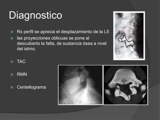 Diagnostico
 Rx perfil se aprecia el desplazamiento de la L5
 las proyecciones oblicuas se pone al
descubierto la falta, de sustancia ósea a nivel
del istmo.
 TAC
 RMN
 Centellograma
 