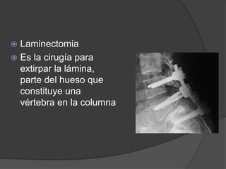  Laminectomia
 Es la cirugía para
extirpar la lámina,
parte del hueso que
constituye una
vértebra en la columna
 