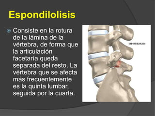 Espondilolisis
 Consiste en la rotura
de la lámina de la
vértebra, de forma que
la articulación
facetaría queda
separada del resto. La
vértebra que se afecta
más frecuentemente
es la quinta lumbar,
seguida por la cuarta.
 
