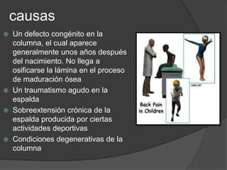 causas
 Un defecto congénito en la
columna, el cual aparece
generalmente unos años después
del nacimiento. No llega a
osificarse la lámina en el proceso
de maduración ósea
 Un traumatismo agudo en la
espalda
 Sobreextensión crónica de la
espalda producida por ciertas
actividades deportivas
 Condiciones degenerativas de la
columna
 