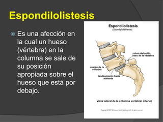 Espondilolistesis
 Es una afección en
la cual un hueso
(vértebra) en la
columna se sale de
su posición
apropiada sobre el
hueso que está por
debajo.
 