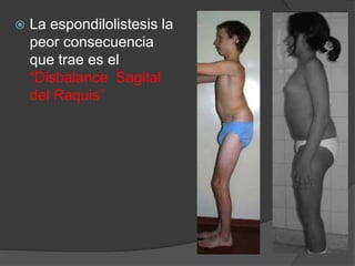  La espondilolistesis la
peor consecuencia
que trae es el
“Disbalance Sagital
del Raquis”
 