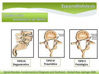 TIPO III
Degenerativa
TIPO IV
Traumática
TIPO V
Patológica
Spinal Disorders. Fundamental of Diagnosis and Treatment. Norbert Boss. Springer 2008
 