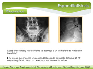 A (espondiloptosis) Y su contorno se asemeja a un "sombrero de Napoleón
invertido".
B Rx lateral que muestra una espondilolistesis de desarrollo (istmica) L5 / S1
Meyerding Grado II con un defecto pars claramente visible.
Spinal Disorders. Fundamental of Diagnosis and Treatment. Norbert Boss. Springer 2008
 