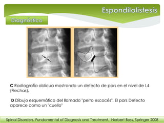 C Radiografía oblicua mostrando un defecto de pars en el nivel de L4
(Flechas).
D Dibujo esquemático del llamado "perro escocés". El pars Defecto
aparece como un "cuello"
Spinal Disorders. Fundamental of Diagnosis and Treatment. Norbert Boss. Springer 2008
 