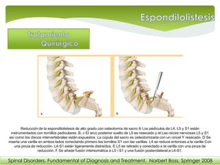 Spinal Disorders. Fundamental of Diagnosis and Treatment. Norbert Boss. Springer 2008
Reducción de la espondilolistesis de alto grado con osteotomía de sacro A Los pedículos de L4, L5 y S1 están
instrumentados con tornillos pediculares. B, c El arco posterior suelto de L5 es resecado y el Las raíces nerviosas L5 y S1
así como los discos intervertebrales están expuestos. La cúpula del sacro es osteotomizada con un cincel Y resecado. D Se
inserta una varilla en ambos lados conectando primero los tornillos S1 con las varillas. L4 se reduce entonces a la varilla Con
una pinza de reducción. L4-S1 están ligeramente distraídos. E L5 es retirado y conectado a la varilla con una pinza de
reducción. F Se añade fusión intersomática a L5 / S1 y una fusión posterolateral a L4-S1.
 