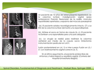 Un paciente de 10 años de edad presentó hiperlordosis de
la columna lumbar, malalignación sagital (paso
lumbosacro) Posición flexionada de la rodilla, músculos
isquiotibiales apretados y espasmo del músculo paraespinal
(a). El paciente estaba neurológicamente intacto. CT y La
RM de la columna lumbar demostró una espondiloptosis
(b). Nótese el sacro en forma de cúpula (b, c). El paciente
no Exhiben una espondilolisis pero una pars alargada
(c). La cirugía se realizó para realinear la columna
vertebral por medio de la cúpula sacra Osteotomía
instrumentación pedicular en L4-S1,
fusión posterolateral en L4 / 5 e inter-cuerpo Fusión en L5 /
S1 con realineamiento sagital correcto (e, f).
En el último seguimiento, el paciente estaba libre de
síntomas y había Mejoró su equilibrio sagital. (Cortesía del
Hospital Universitario Balgrist)
Spinal Disorders. Fundamental of Diagnosis and Treatment. Norbert Boss. Springer 2008
 