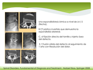 Una espondilolistesis istmica a nivel de L4 / 5
(flecha).
B CT pórtico invertido que demuestra la
espondilolisis bilateral.
C, d Fijación directa del tornillo y injerto óseo
del defecto.
E, f Fusión sólida del defecto al seguimiento de
1 año con Resolución del dolor.
Spinal Disorders. Fundamental of Diagnosis and Treatment. Norbert Boss. Springer 2008
 