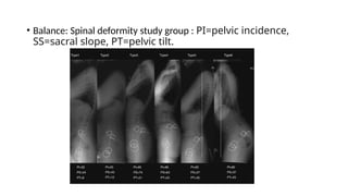 • Balance: Spinal deformity study group : PI=pelvic incidence,
SS=sacral slope, PT=pelvic tilt.
 