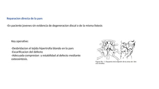 Reparacion directa de la pars
-En paciente jovenes sin evidencia de degeneracion discal o de la misma listesis
Key operative:
-Desbridacion el tejido hipertrofia blando en la pars
-Escarificacion del defecto
-Adecuada compresion y estabilidad al defecto mediante
osteosintesis.
 