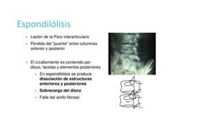Espondilólisis
 