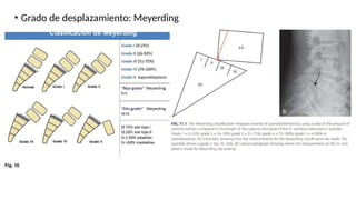 • Grado de desplazamiento: Meyerding
 