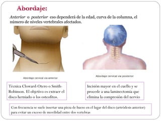 Anterior o posterior eso dependerá de la edad, curva de la columna, el
número de niveles vertebrales afectados.

Técnica Cloward-Otero o SmithRobinson. El objetivo es extraer el
disco herniado o los osteofitos.

Incisión mayor en el cuello y se
procede a una laminectomia que
elimina la compresión del nervio

Con frecuencia se suele insertar una pieza de hueso en el lugar del disco (artródesis anterior)
para evitar un exceso de movilidad entre dos vertebras

 