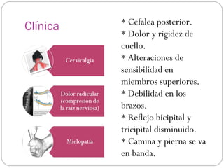 Clínica

* Cefalea posterior.
* Dolor y rigidez de
cuello.
* Alteraciones de
sensibilidad en
miembros superiores.
* Debilidad en los
brazos.
* Reflejo bicipital y
tricipital disminuido.
* Camina y pierna se va
en banda.

 