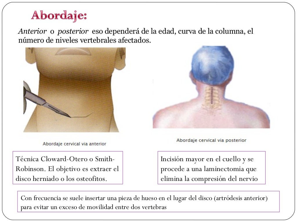 Espondilosis Cervical