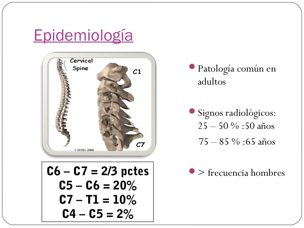Espondilosis Cervical
