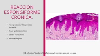 REACCION
ESPONGIFORME
CRONICA.
 Hiperqueratosis u Ortoqueratosis
compacta.
 Mayor grado de acantosis
 Cambio psoriasiforme
 Escasa espongiosis
R.B Johnston,Weedon's Skin Pathology Essentials, 2011 pp; 121-153.
 
