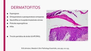 DERMATOFITOS
■ Espongiosis
■ Ortoqueratosis o paraqueratosis compactas
■ Neutrófilos en la epidermis/estrato córneo
■ Pústulas espongióticas
■ Hifas
■ Tinción periódica de ácido-Schiff (PAS).
R.B Johnston,Weedon's Skin Pathology Essentials, 2011 pp; 121-153.
 