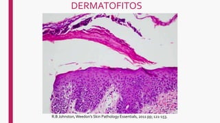 DERMATOFITOS
R.B Johnston,Weedon's Skin Pathology Essentials, 2011 pp; 121-153.
 