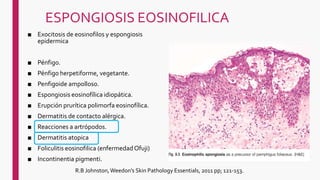 ESPONGIOSIS EOSINOFILICA
■ Exocitosis de eosinofilos y espongiosis
epidermica
■ Pénfigo.
■ Pénfigo herpetiforme, vegetante.
■ Penfigoide ampolloso.
■ Espongiosis eosinofílica idiopática.
■ Erupción prurítica polimorfa eosinofílica.
■ Dermatitis de contacto alérgica.
■ Reacciones a artrópodos.
■ Dermatitis atopica
■ Foliculitis eosinofilica (enfermedad Ofuji)
■ Incontinentia pigmenti.
R.B Johnston,Weedon's Skin Pathology Essentials, 2011 pp; 121-153.
 
