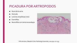 PICADURA PORARTROPODOS
■ Ácaro de la sarna
■ Vesículas
■ Lesiones ampollosas (raro)
■ Eosinófilos
■ Neutrofílos con ciertos escarabajos
R.B Johnston, Weedon's Skin Pathology Essentials, 2011 pp; 121-153.
 