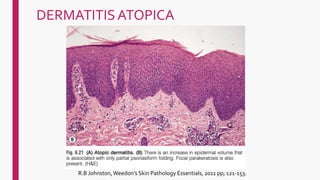 DERMATITISATOPICA
R.B Johnston, Weedon's Skin Pathology Essentials, 2011 pp; 121-153.
 