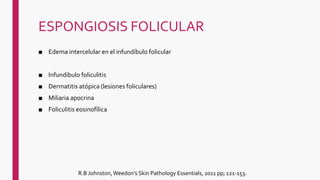 ESPONGIOSIS FOLICULAR
■ Edema intercelular en el infundíbulo folicular
■ Infundibulo foliculitis
■ Dermatitis atópica (lesiones foliculares)
■ Miliaria apocrina
■ Foliculitis eosinofílica
R.B Johnston, Weedon's Skin Pathology Essentials, 2011 pp; 121-153.
 