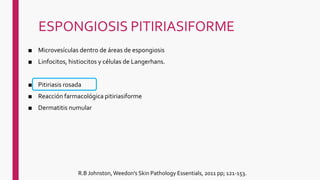 ESPONGIOSIS PITIRIASIFORME
■ Microvesículas dentro de áreas de espongiosis
■ Linfocitos, histiocitos y células de Langerhans.
■ Pitiriasis rosada
■ Reacción farmacológica pitiriasiforme
■ Dermatitis numular
R.B Johnston, Weedon's Skin Pathology Essentials, 2011 pp; 121-153.
 
