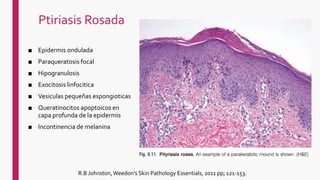 Ptiriasis Rosada
■ Epidermis ondulada
■ Paraqueratosis focal
■ Hipogranulosis
■ Exocitosis linfocitica
■ Vesiculas pequeñas espongioticas
■ Queratinocitos apoptoicos en
capa profunda de la epidermis
■ Incontinencia de melanina
R.B Johnston, Weedon's Skin Pathology Essentials, 2011 pp; 121-153.
 