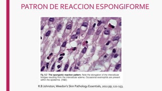 PATRON DE REACCION ESPONGIFORME
R.B Johnston,Weedon's Skin Pathology Essentials, 2011 pp; 121-153.
 
