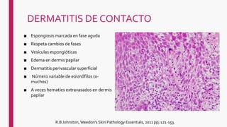 DERMATITIS DE CONTACTO
■ Espongiosis marcada en fase aguda
■ Respeta cambios de fases
■ Vesículas espongióticas
■ Edema en dermis papilar
■ Dermatitis perivascular superficial
■ Número variable de eosinófilos (0-
muchos)
■ A veces hematíes extravasados en dermis
papilar
R.B Johnston, Weedon's Skin Pathology Essentials, 2011 pp; 121-153.
 