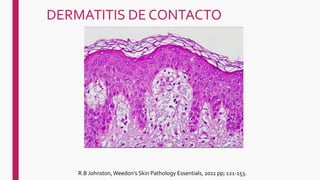 DERMATITIS DE CONTACTO
R.B Johnston, Weedon's Skin Pathology Essentials, 2011 pp; 121-153.
 