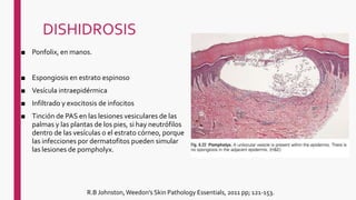 DISHIDROSIS
■ Ponfolix, en manos.
■ Espongiosis en estrato espinoso
■ Vesícula intraepidérmica
■ Infiltrado y exocitosis de infocitos
■ Tinción de PAS en las lesiones vesiculares de las
palmas y las plantas de los pies, si hay neutrófilos
dentro de las vesículas o el estrato córneo, porque
las infecciones por dermatofitos pueden simular
las lesiones de pompholyx.
R.B Johnston, Weedon's Skin Pathology Essentials, 2011 pp; 121-153.
 