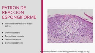 PATRON DE
REACCION
ESPONGIFORME
■ Principales enfermedades de este
patron:
■ Dermatitis atopica
■ Dermatitis de contacto
■ Dermatitis numular
■ Dermatitis seborreica
R.B Johnston, Weedon's Skin Pathology Essentials, 2011 pp; 121-153.
 