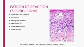 PATRON DE REACCION
ESPONGIFORME
■ Dermatosis por contacto
■ Dishidrosis
■ Prurigo por insectos
■ Ptiriasis rosada
■ Dermatitis atopica
■ Dermatofitos
R.B Johnston,Weedon's Skin Pathology Essentials, 2011 pp; 121-153.
 